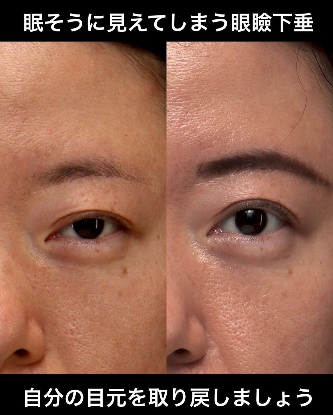 眼瞼下垂手術で本来の自分の目元を取り戻した症例