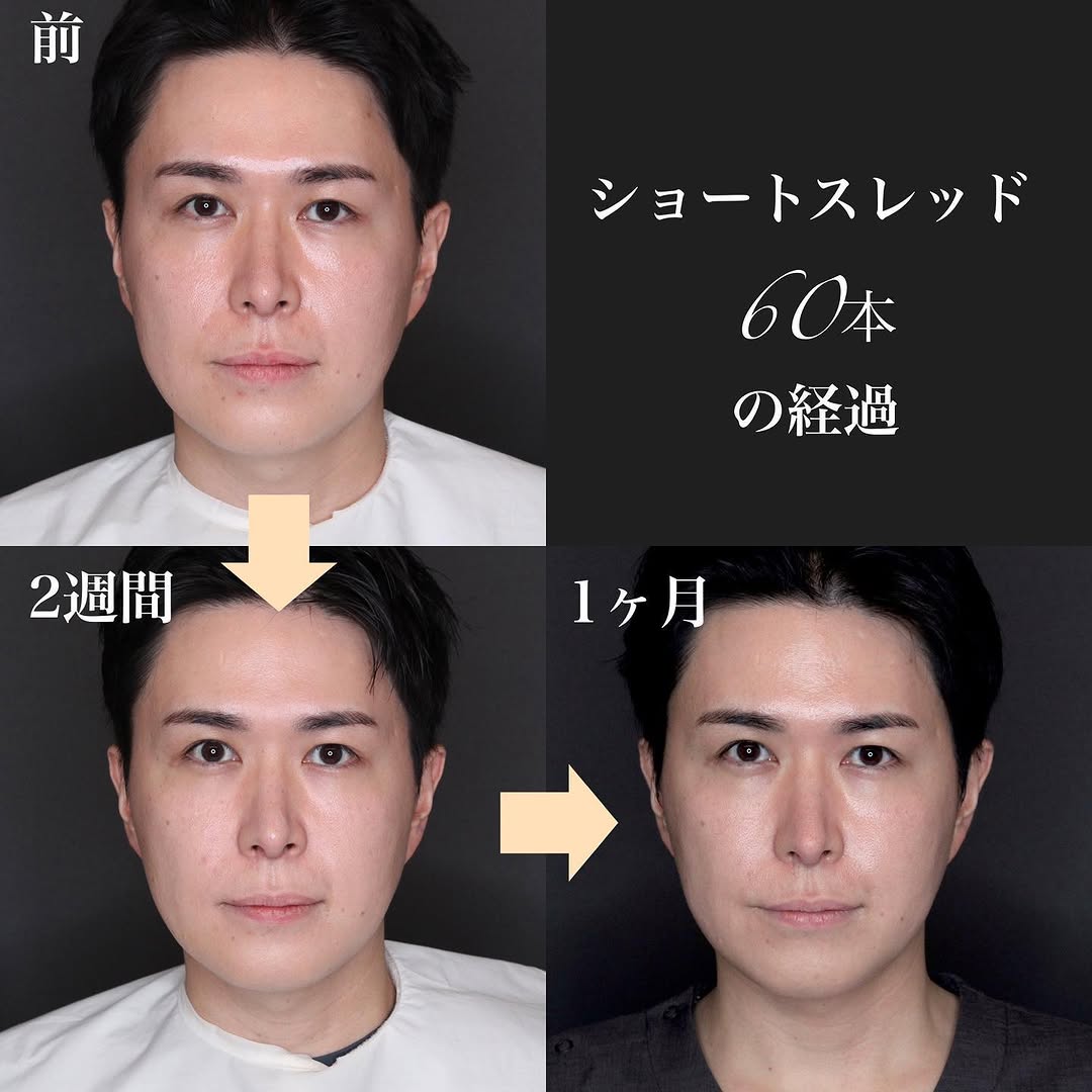 ショートスレッドで口横のたるみ・ゆるみを引き締めた症例（施術後1ヶ月）