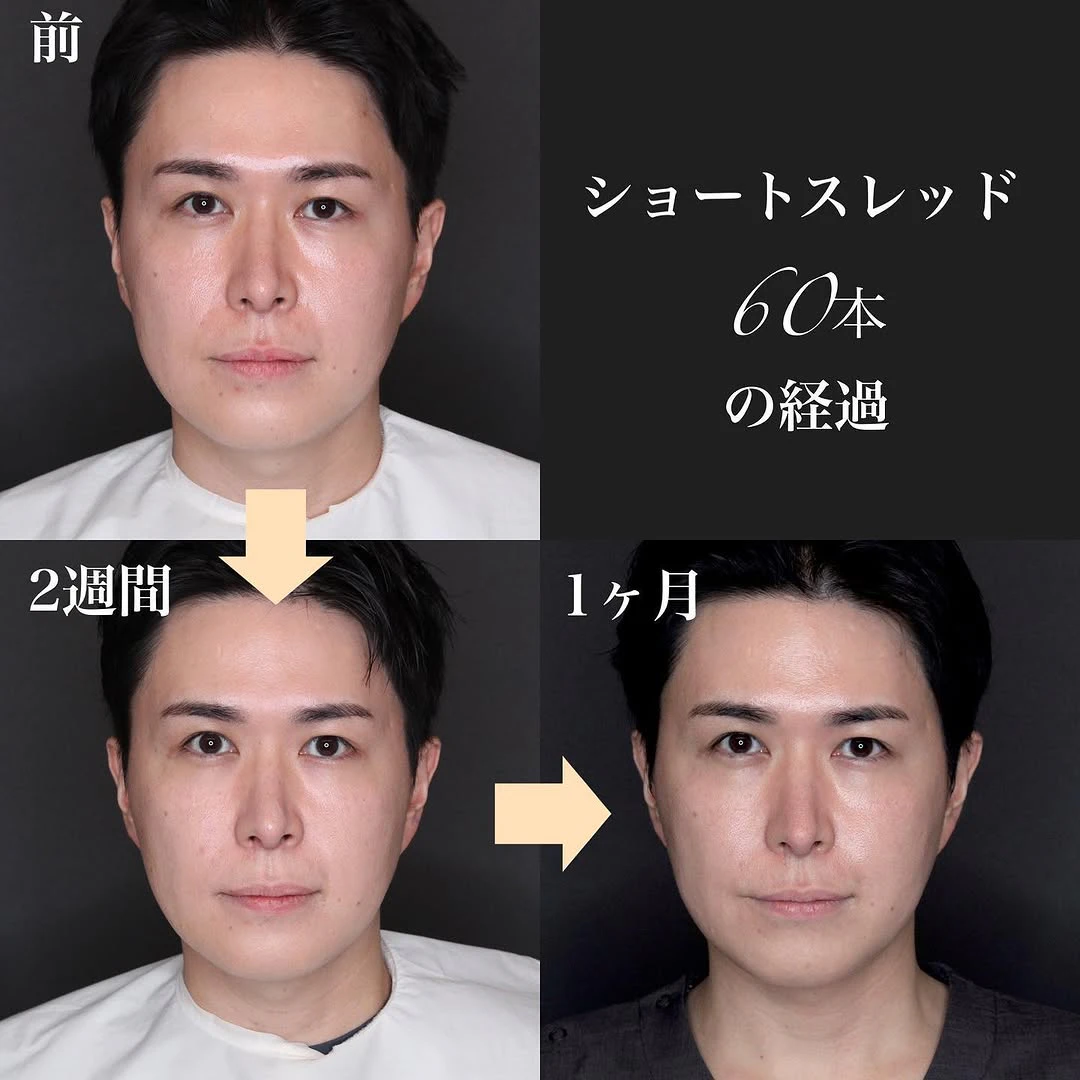 ショートスレッドで口横のたるみ・ゆるみを引き締めた症例(施術後1ヶ月)