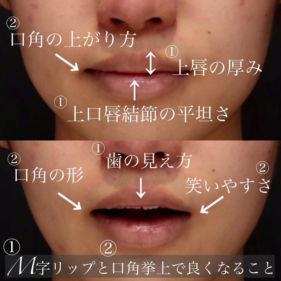 M字リップと口角挙上の組み合わせで口元の印象を整える（術後1週間） 画像2