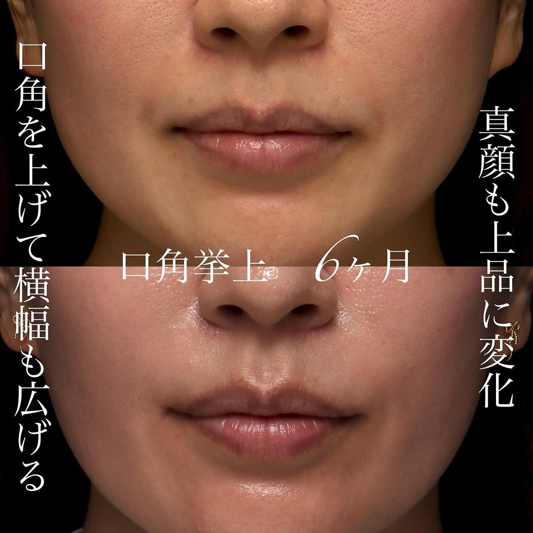 口角挙上で笑いやすさと笑顔の印象を同時に改善した症例 画像2