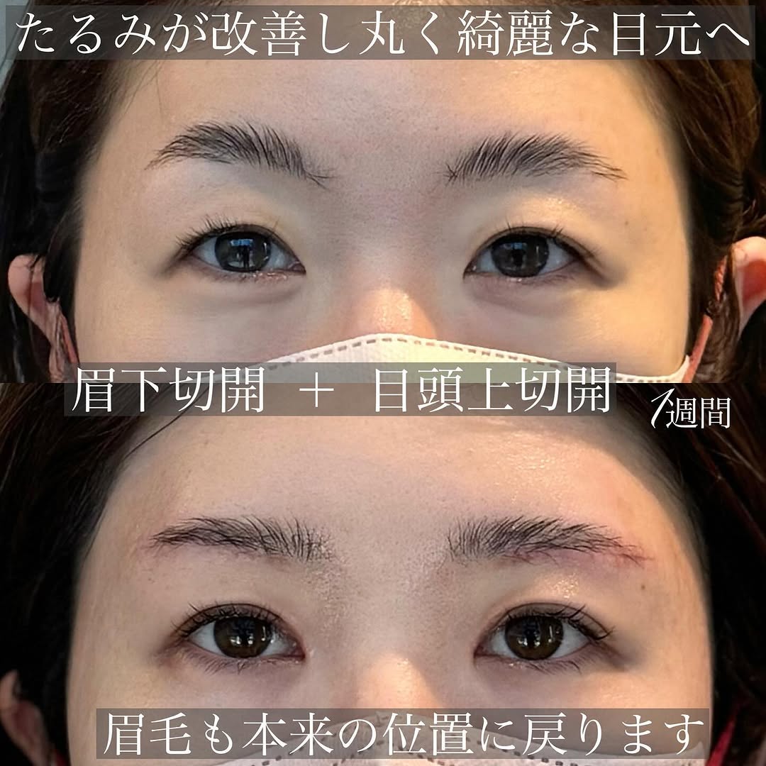 眉下切開＋目頭上切開でまぶたを全体的にすっきりさせた症例（術後1週間）