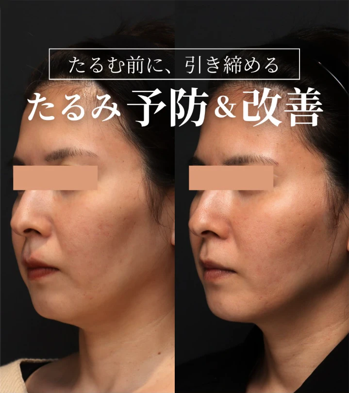 ショートスレッド+ヒアルロン酸でフェイスラインを引き締め頬のくぼみを整えた症例(3ヶ月後)