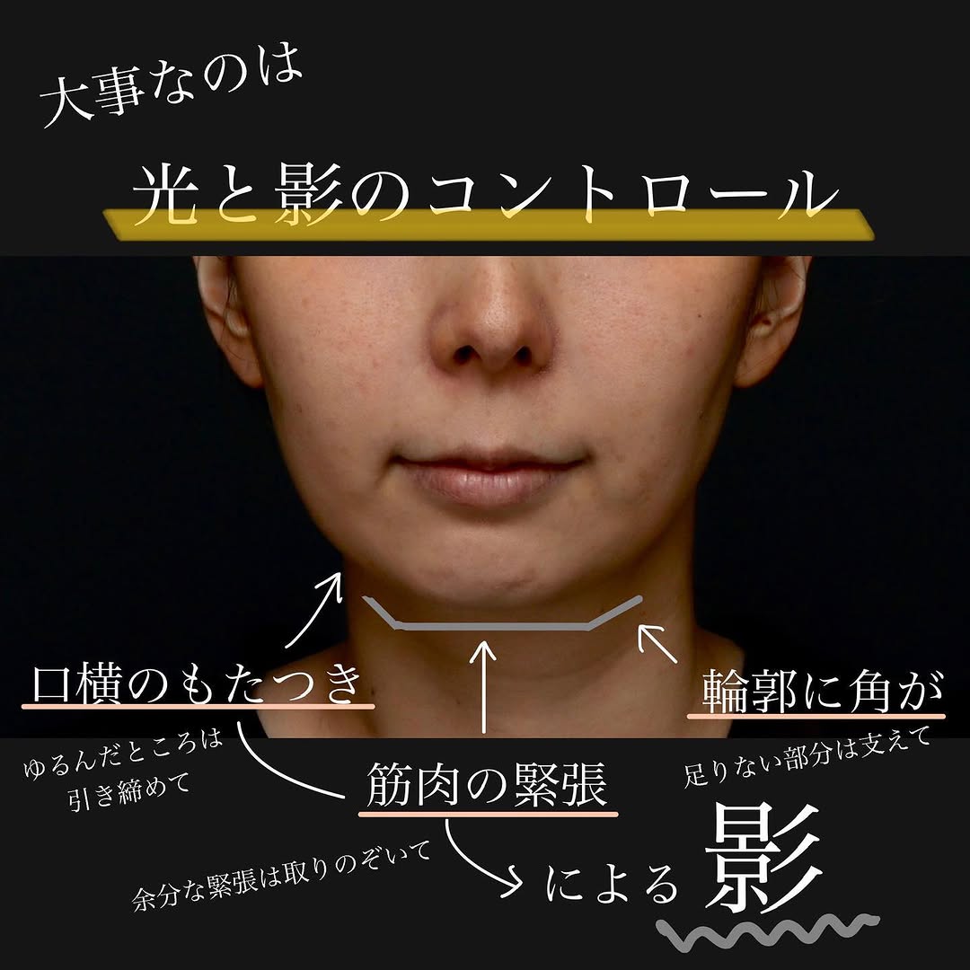 ボトックス×ヒアルロン酸×サーマジェンのコンビネーション治療で下顔面を整えた症例 画像2