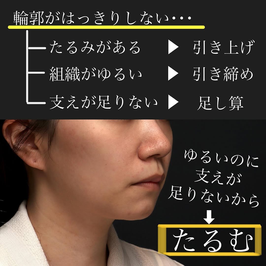 糸リフト＋サーマジェン＋ヒアルロン酸＋ボトックスのコンビネーションでバランス良く小顔に整えた症例 画像3
