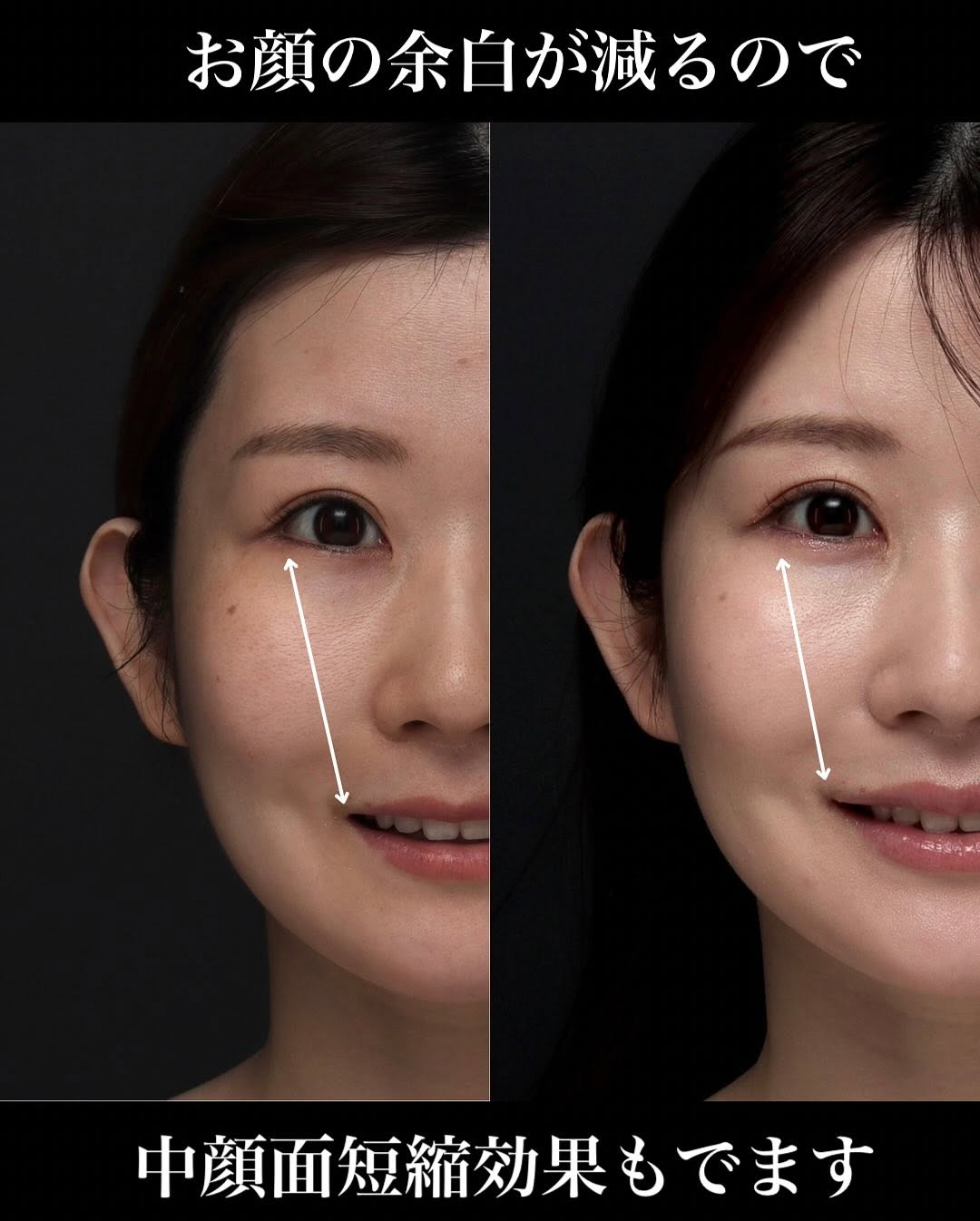 口角挙上＋ヒアルロン酸で術後6ヶ月笑顔が格段に良くなった症例 画像4