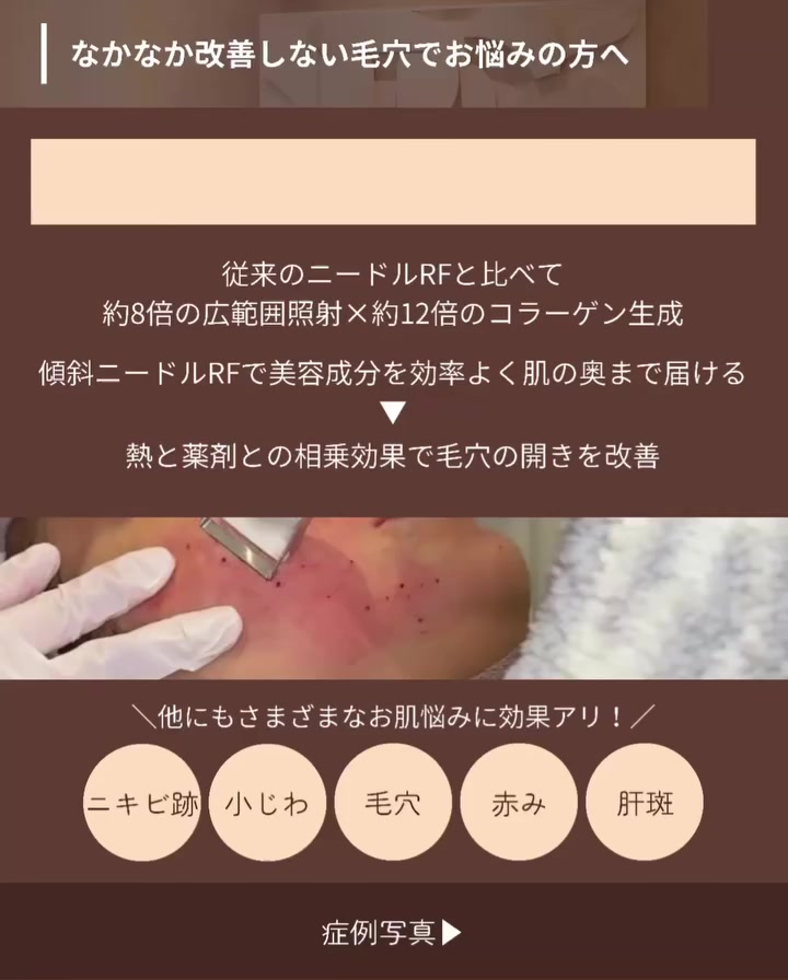 ブレッシングで毛穴レス肌を目指した広範囲ニードルRFと薬剤の複合施術症例 画像2