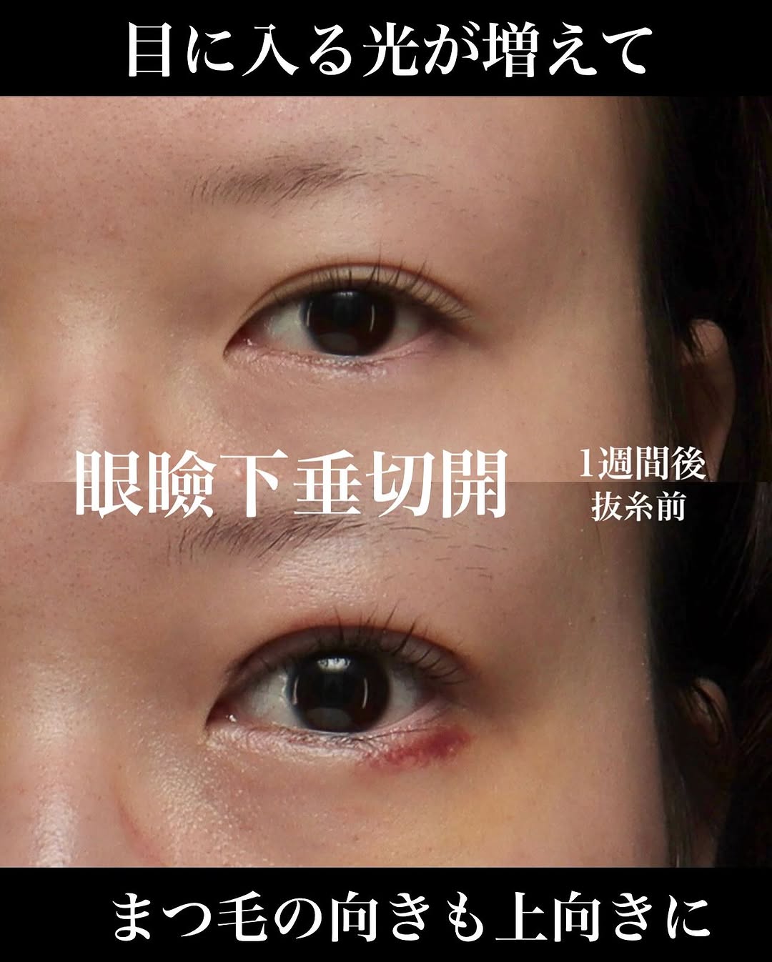 眼瞼下垂手術で黒目全体が見えるようになりまつ毛も上向きになった症例（術後1週間）