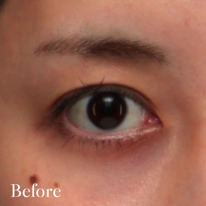 20代の眉下切開でまぶたの被さりを改善し本来の二重ラインを取り戻した症例 画像5