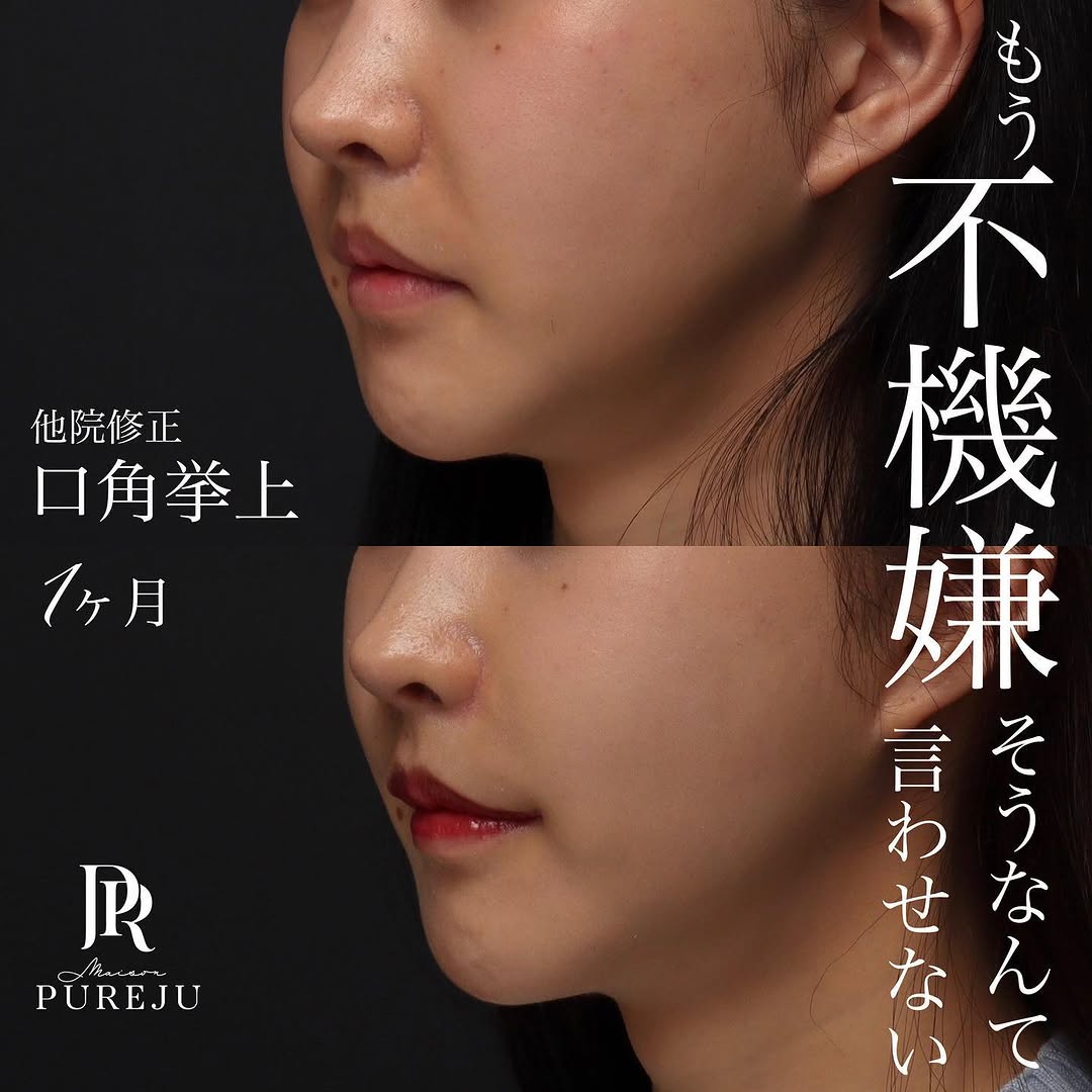 他院修正の口角挙上でしっかりと口角を上げ印象を改善した症例（術後1ヶ月） 画像2