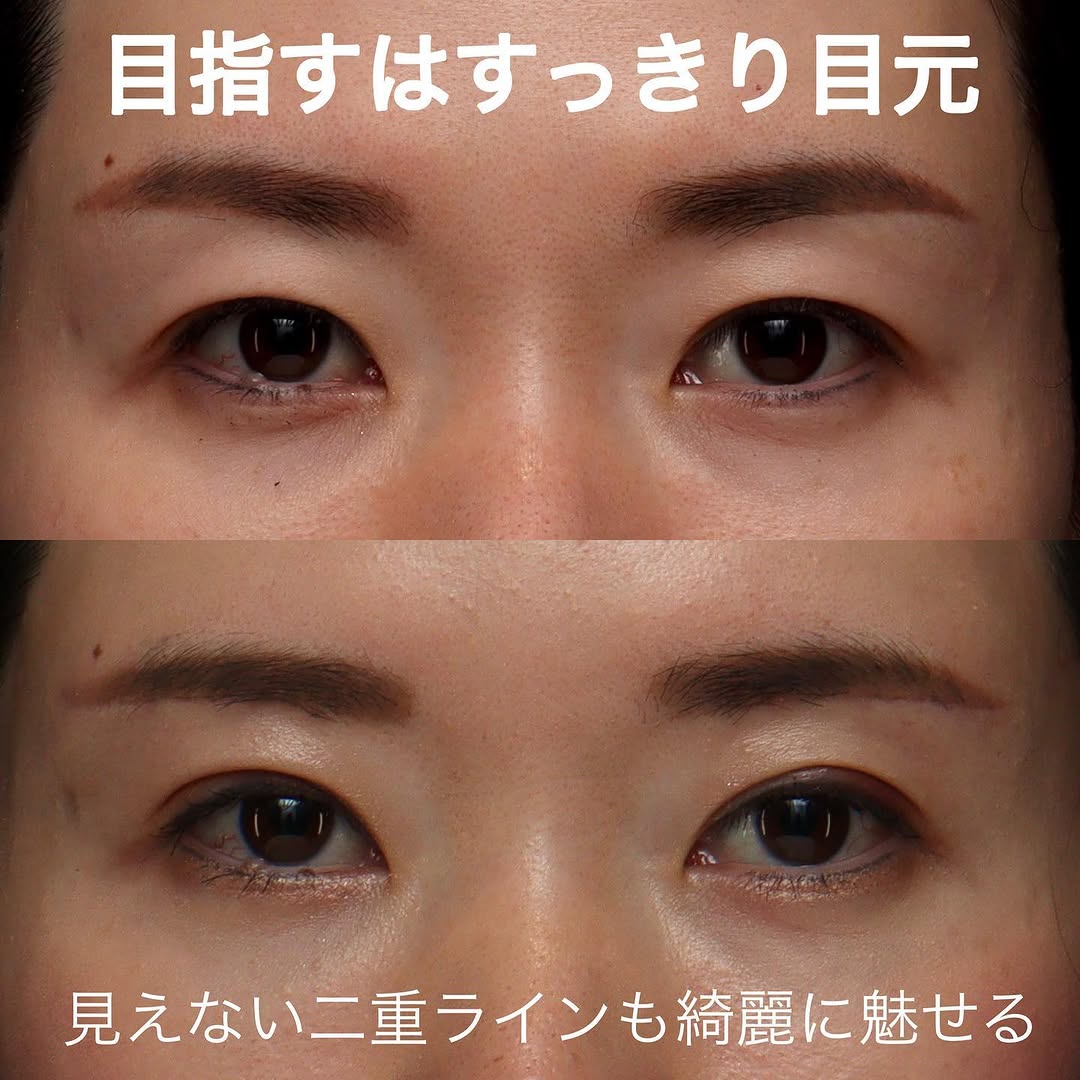 眉下切開＋二重埋没でたるみで隠れていた二重ラインをすっきり出した症例