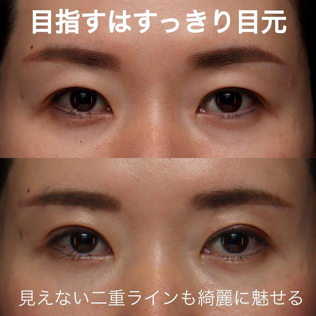 眉下切開+二重埋没でたるみで隠れていた二重ラインをすっきり出した症例