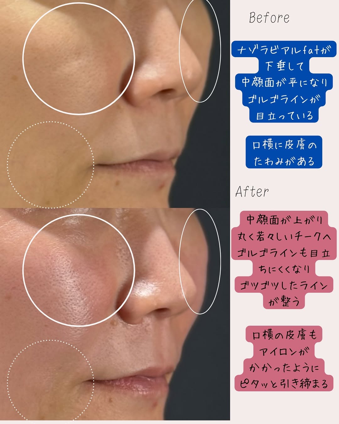 サーマハンドで中顔面を丸く若々しく！ゴルゴライン改善の症例紹介 画像2