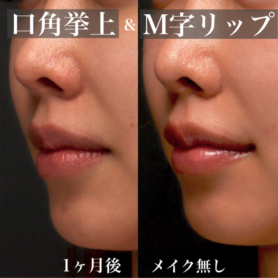 M字リップ＋口角挙上で唇の比率を整え立体感のある口元にした症例（術後1ヶ月） 画像3