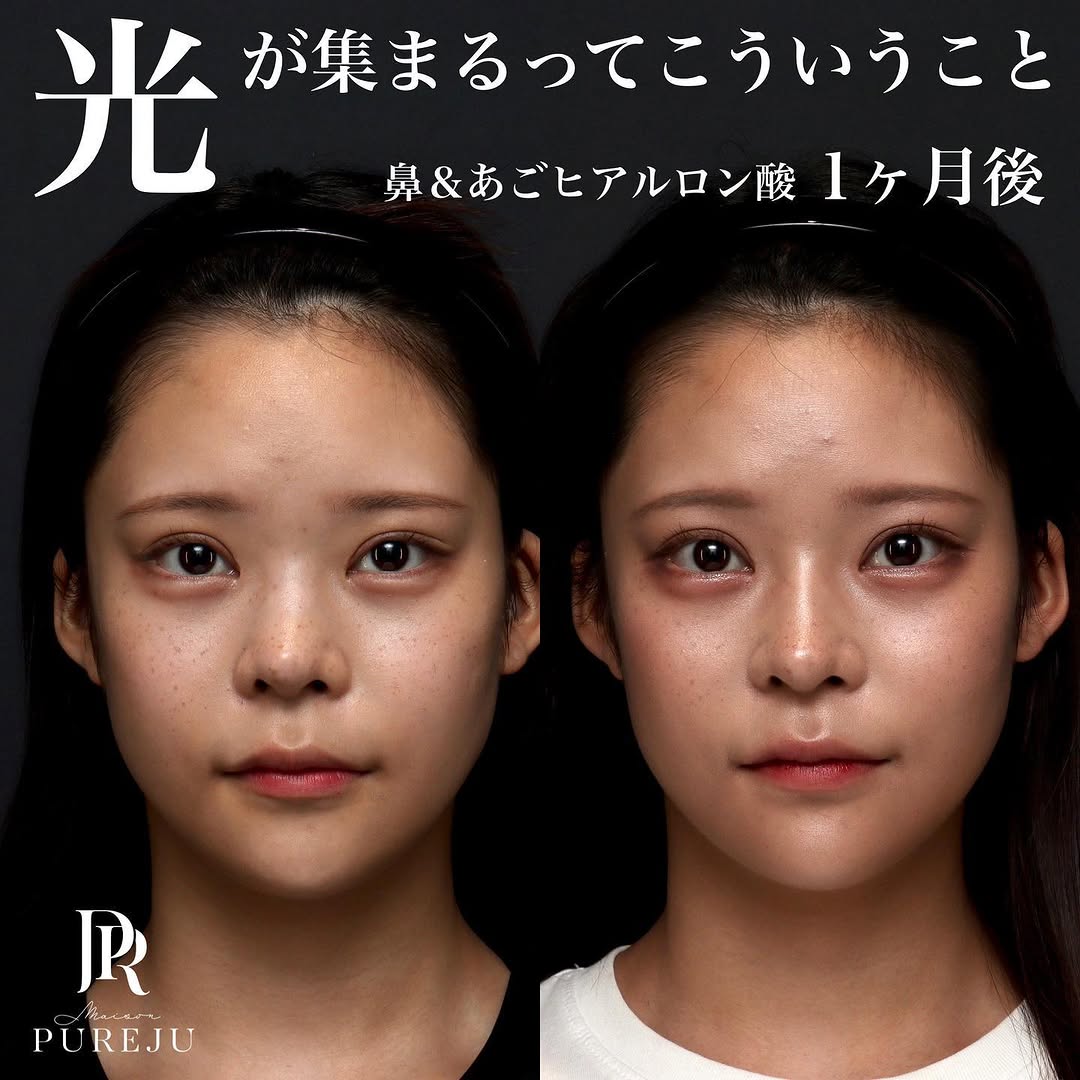 鼻＆あごヒアルロン酸で光の集まり方が変わり華やかな印象になった症例（1ヶ月後）