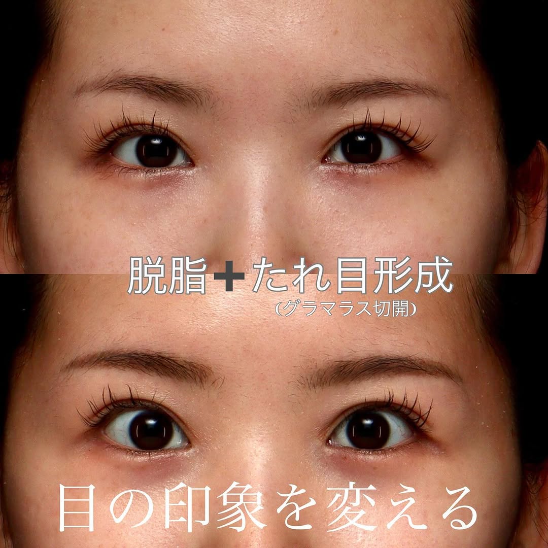 脱脂（くまとり）＋グラマラス（たれ目形成）で中顔面が短く見える丸い目元に整えた症例 画像4