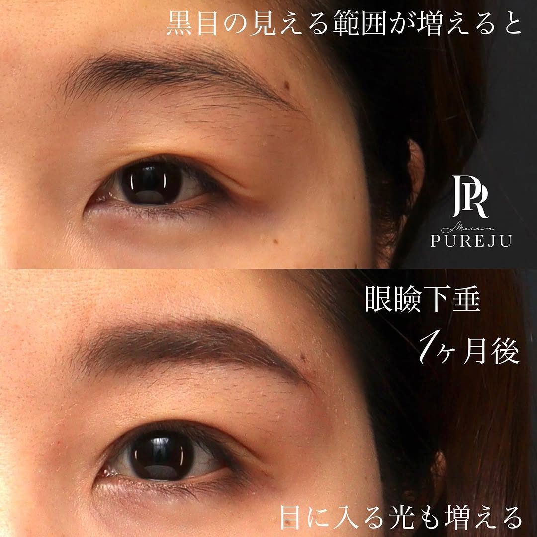 眼瞼下垂手術で黒目の見える範囲が広がり目に入る光が増えた症例（術後1ヶ月）