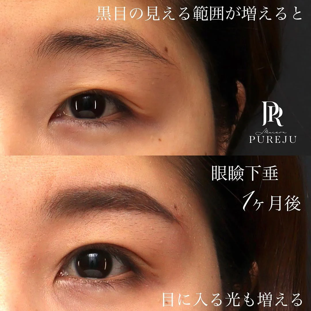 眼瞼下垂手術で黒目の見える範囲が広がり目に入る光が増えた症例(術後1ヶ月)