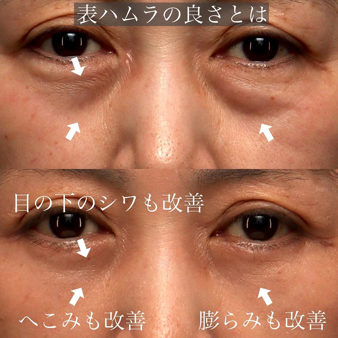 表ハムラでたるみ・膨らみ・へこみをまとめて改善した目の下クマの症例 画像2
