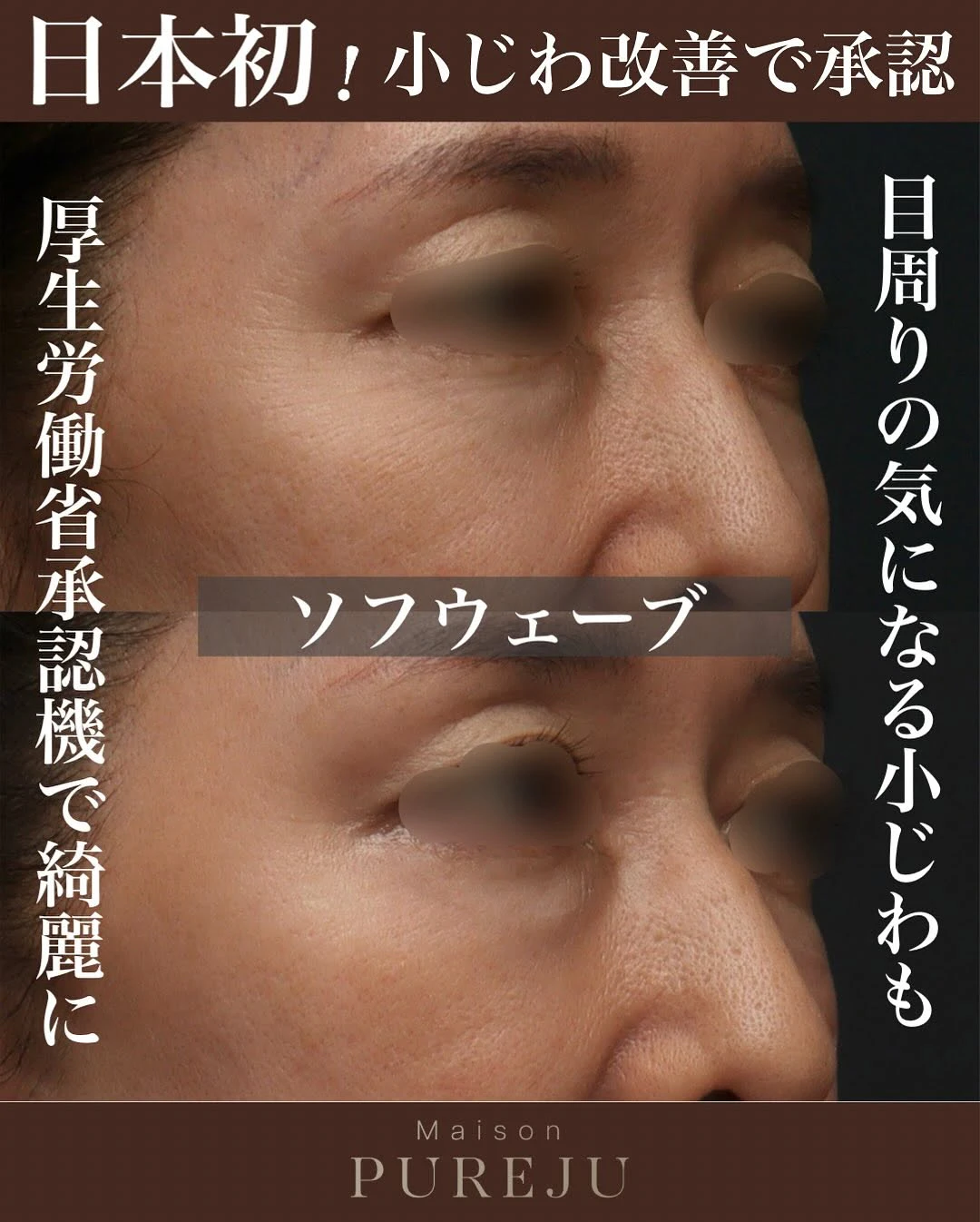 厚生労働省承認機ソフウェーブで小じわとたるみを改善した症例