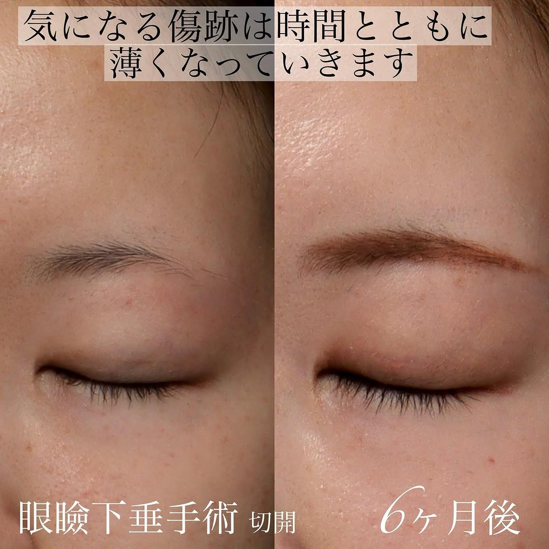 眼瞼下垂手術で黒目全体が見えるようになり目の開きと印象を改善した症例 画像3