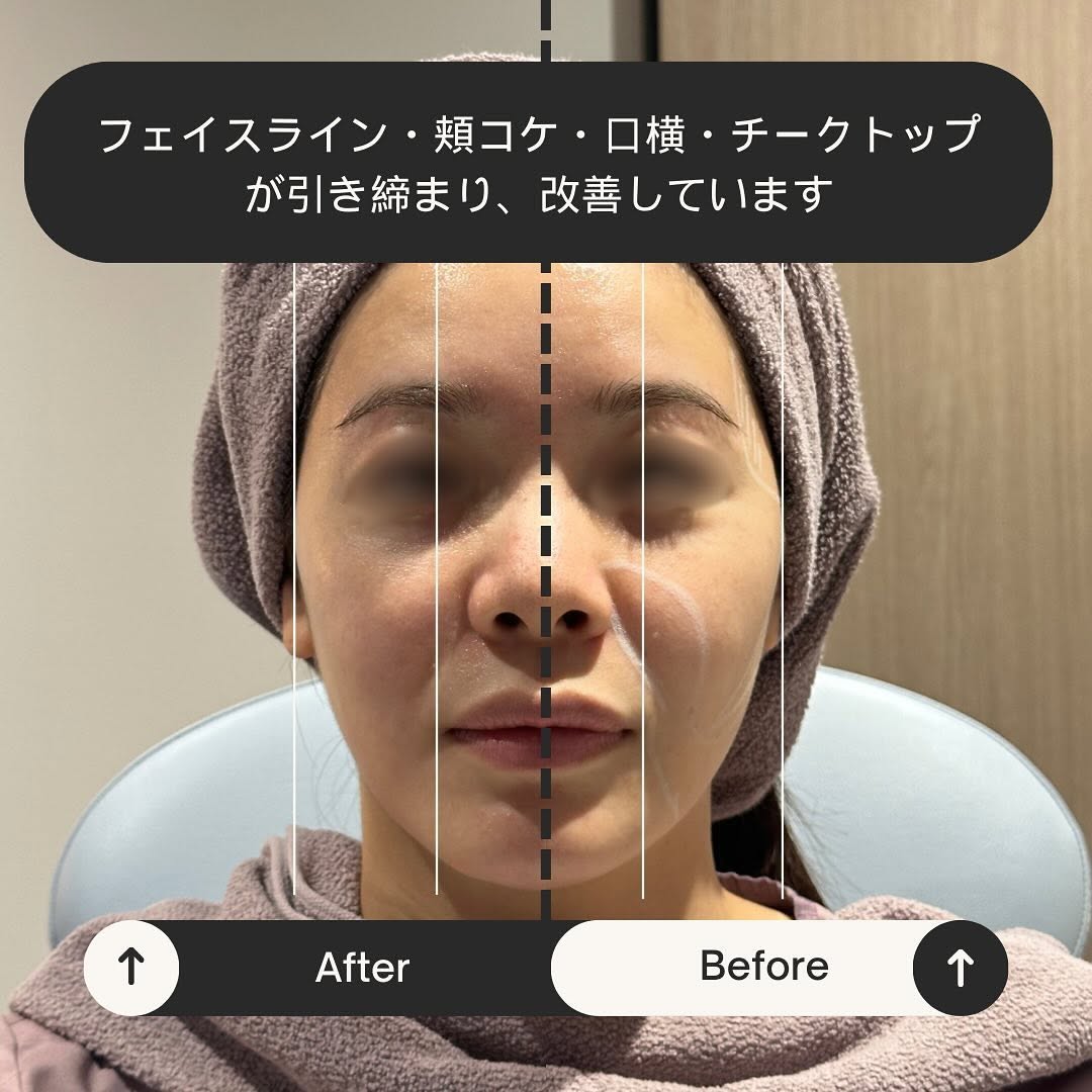 愛してやまないサーマジェン！痛くない・ダウンタイムなし・効果高いの三拍子 画像2
