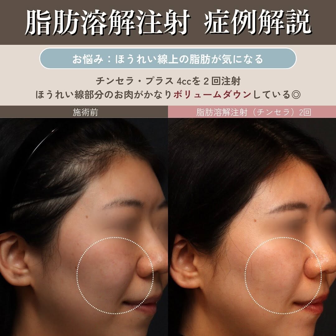脂肪溶解注射は効果ない？｜チンセラプラスのデオキシコール酸濃度と注入量が結果を左右する理由 画像4