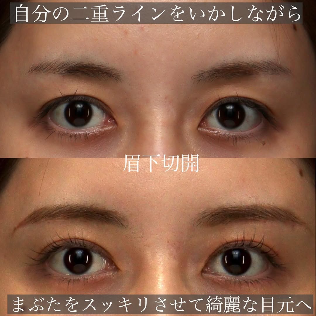 20代の眉下切開でまぶたの被さりを改善し本来の二重ラインを取り戻した症例