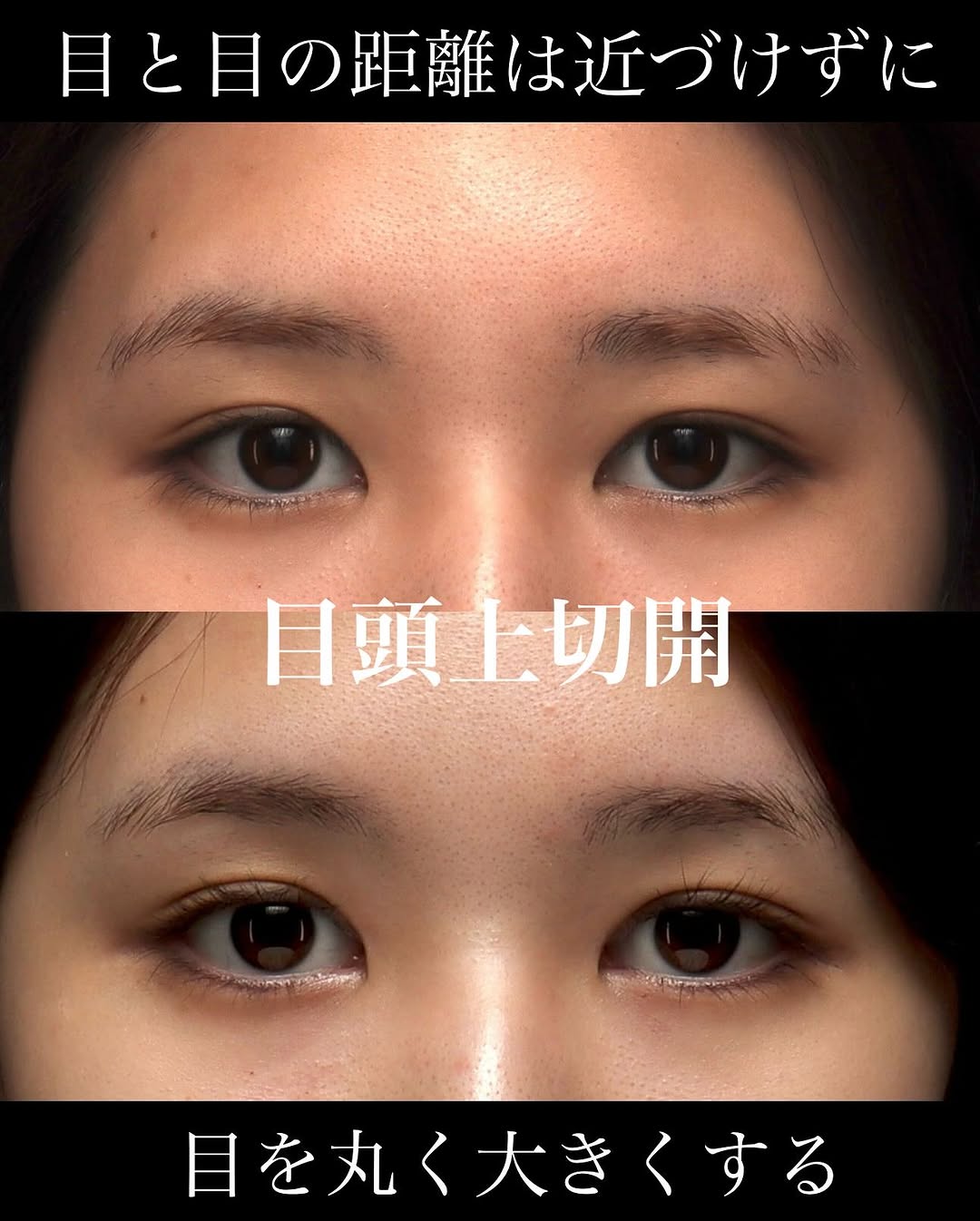 目頭上切開で目頭側のたるみを改善しどこから見てもすっきりした丸い目元に整えた症例 画像4