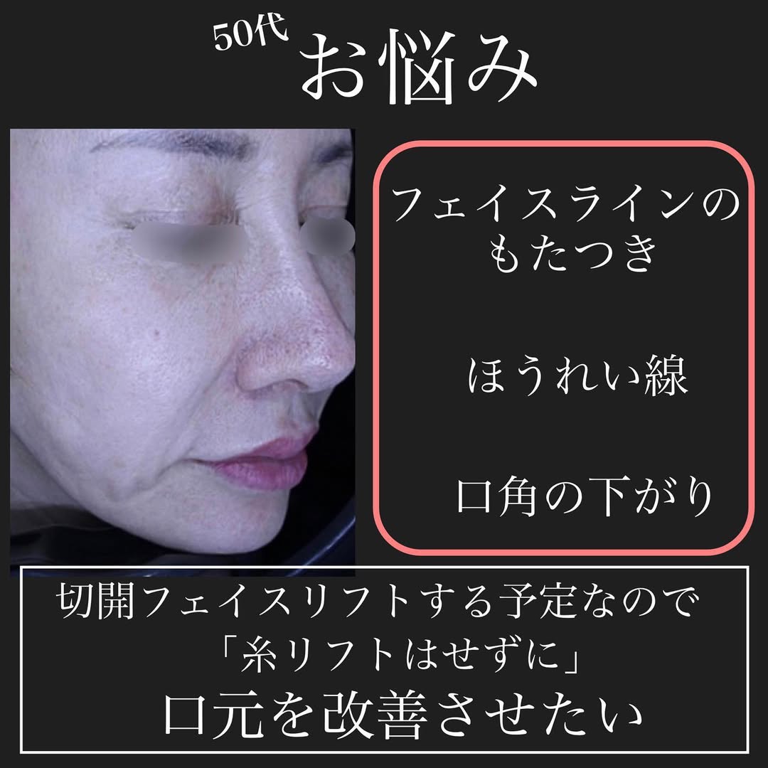 ジャルプロ＋ショートスレッド＋シルキー注射＋口角挙上の複合治療で口横のたるみを整えた症例 画像2
