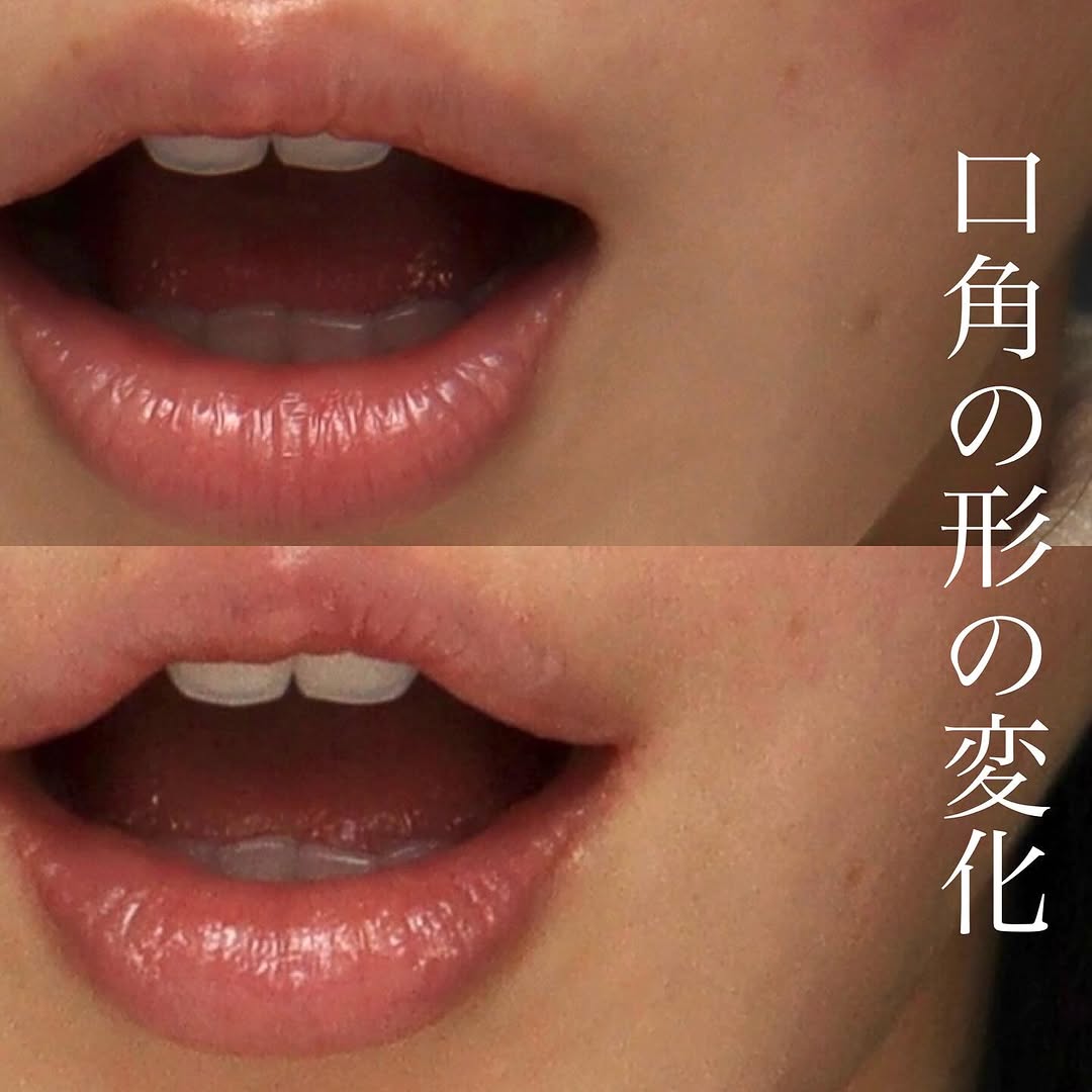 口角挙上でナチュラルに上品な変化を実現した症例 画像3