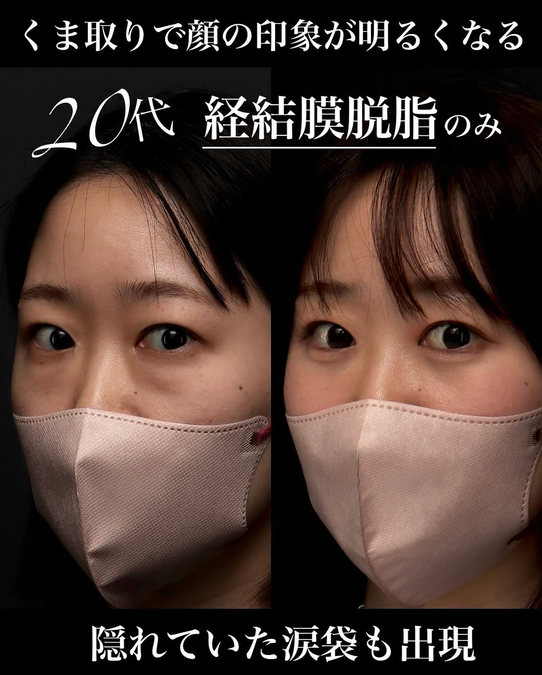 脱脂（経結膜脱脂）で目の下の膨らみを改善し明るく元気な印象になった症例