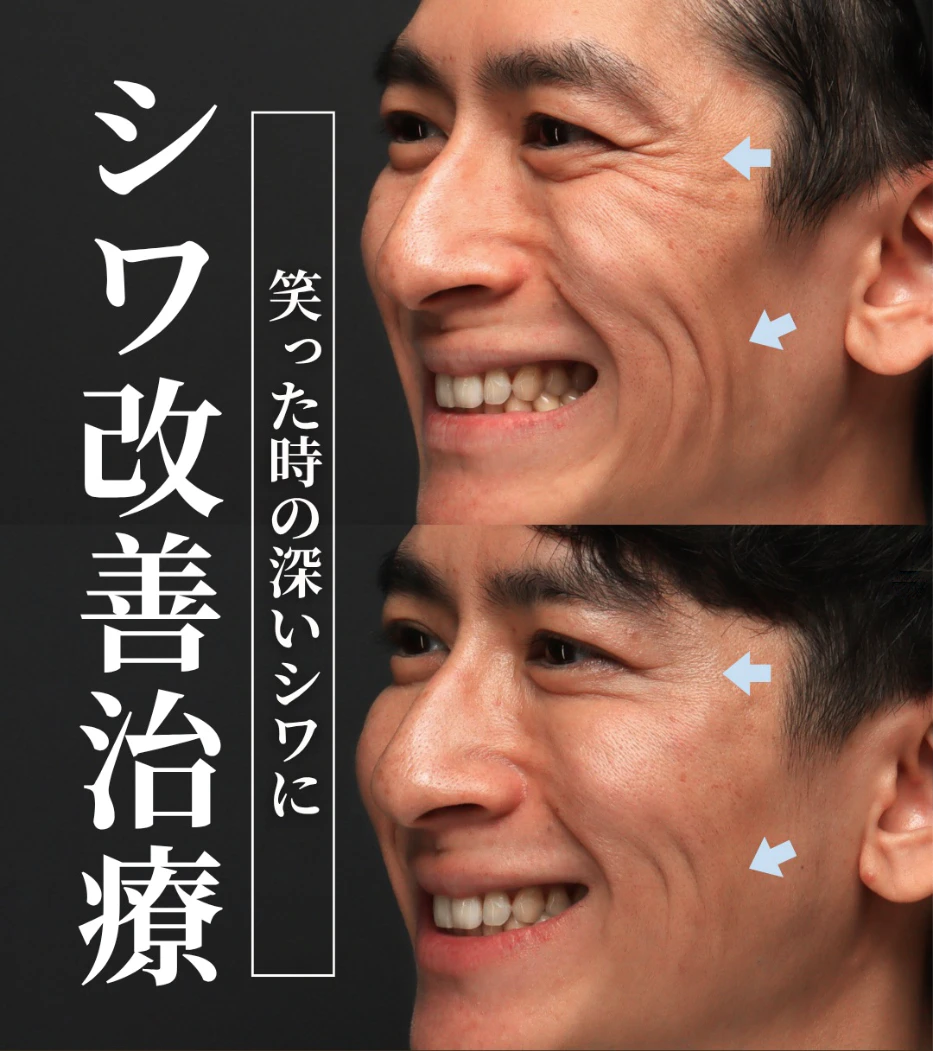 ソフウェーブ×バイオスカルプチャー×ボトックスの複合治療で笑った時の深い表情ジワを改善した症例(1ヶ月後)
