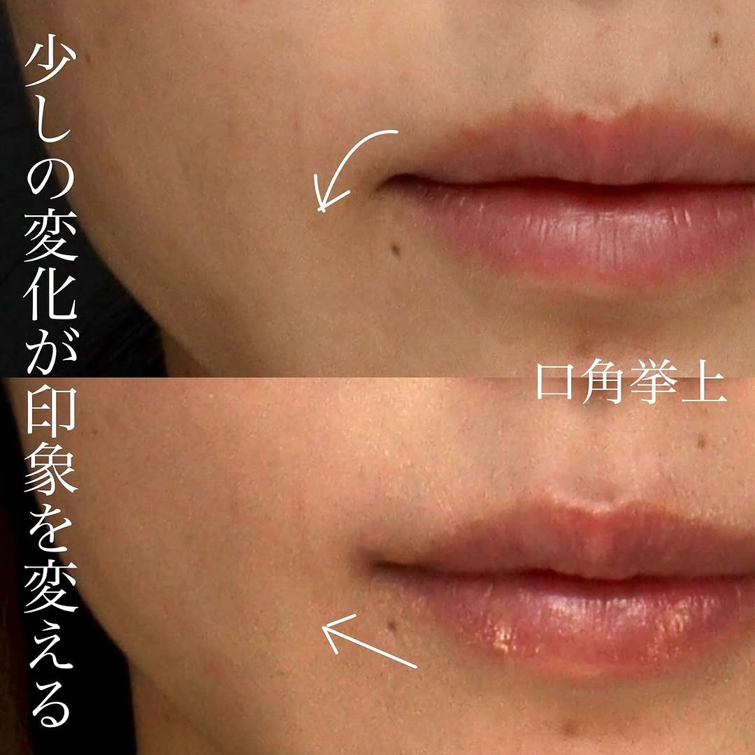 口角挙上でナチュラルに上品な変化を実現した症例 画像2