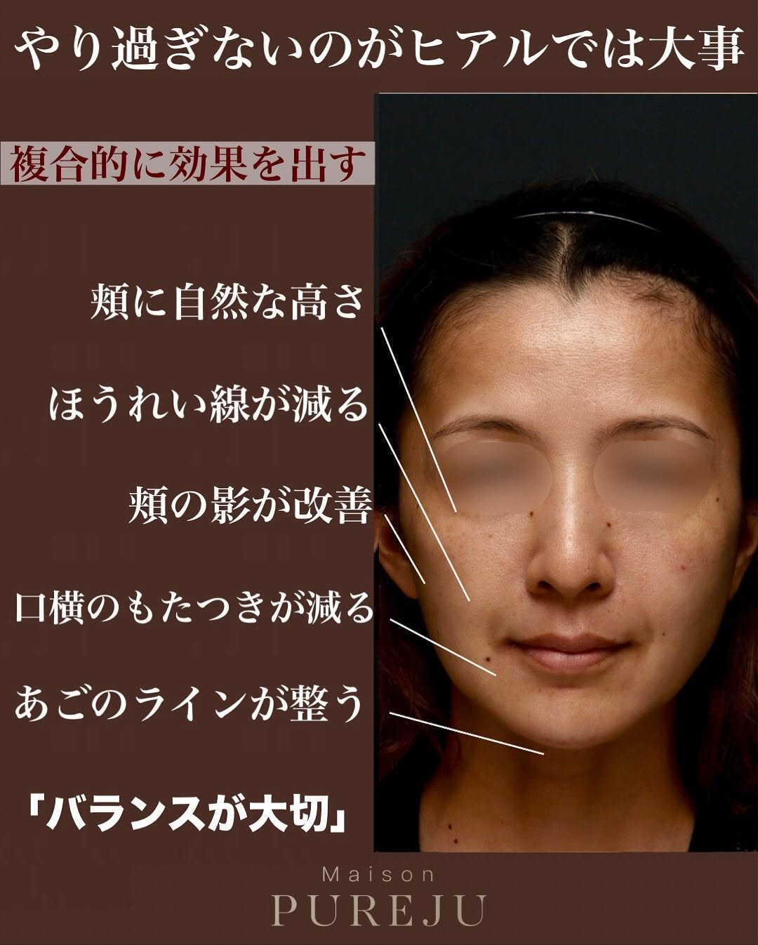ヒアルロン酸注射でバランス良く整え自然にリフトアップした症例 画像3
