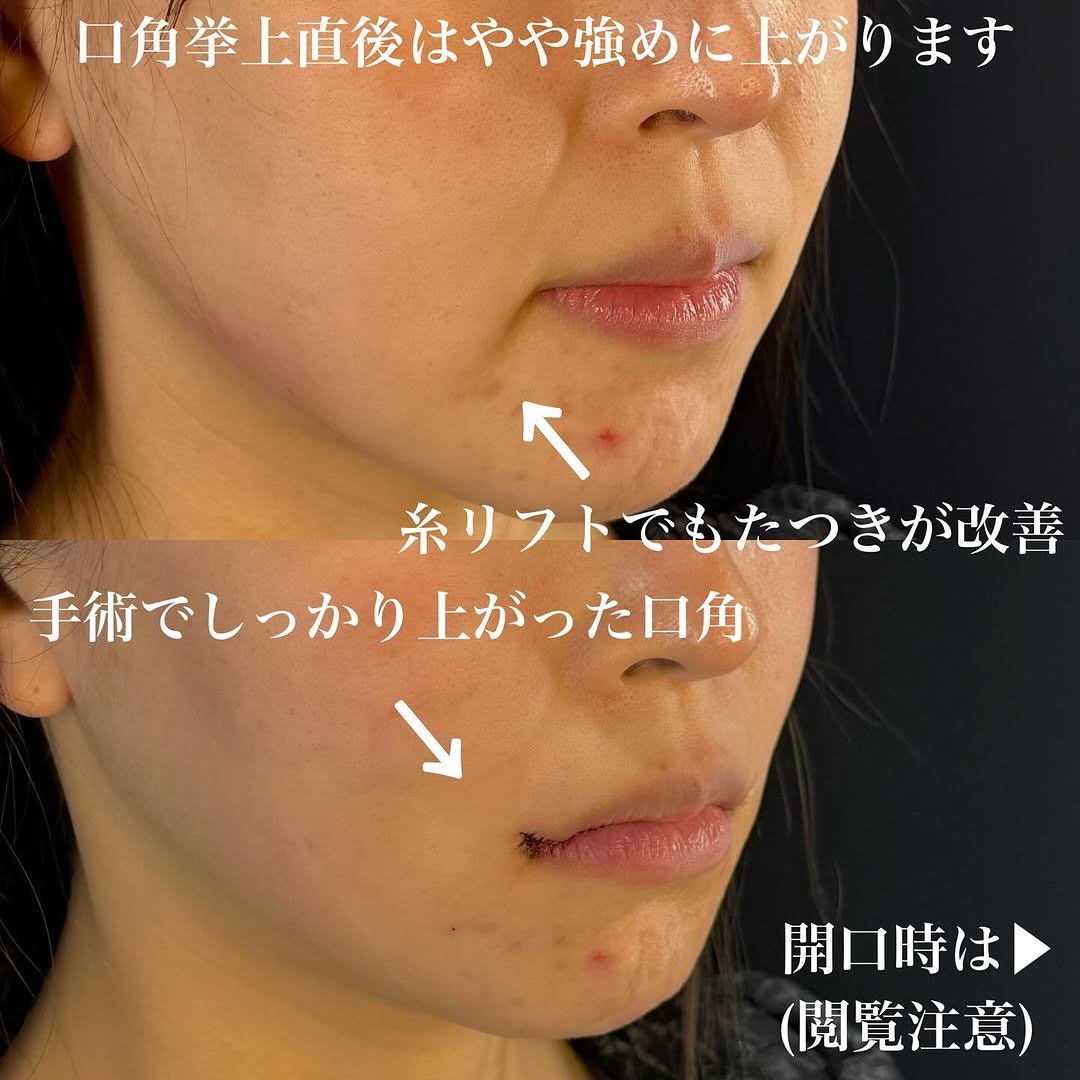 口角挙上＋糸リフトの直後ダウンタイム経過を示した症例 画像3