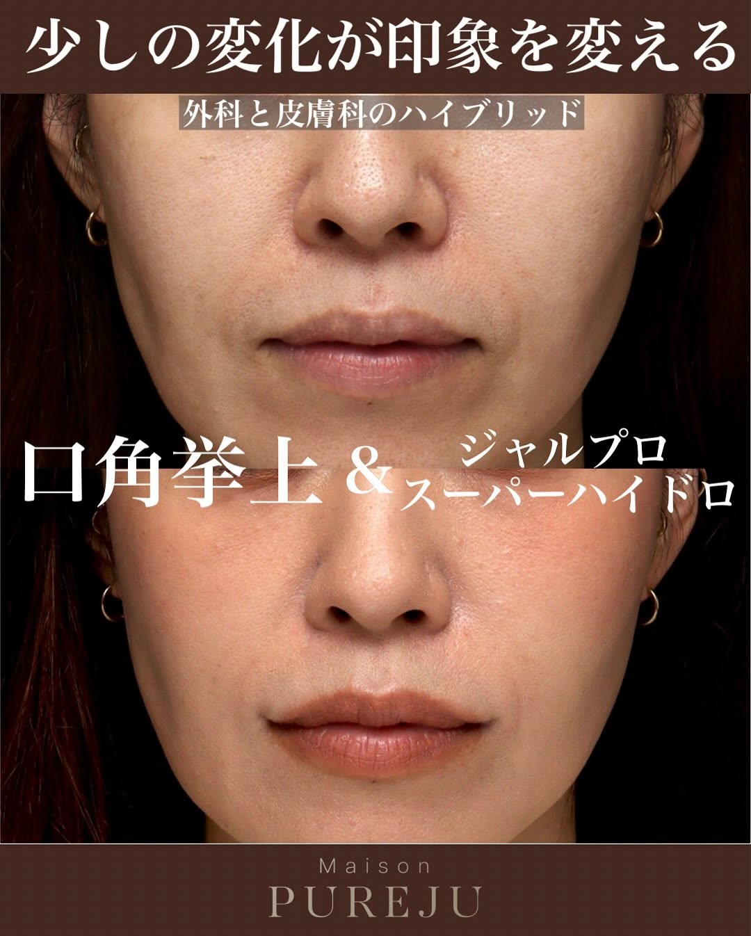 口角挙上＋ジャルプロスーパーハイドロで口元の若返りを実現した症例