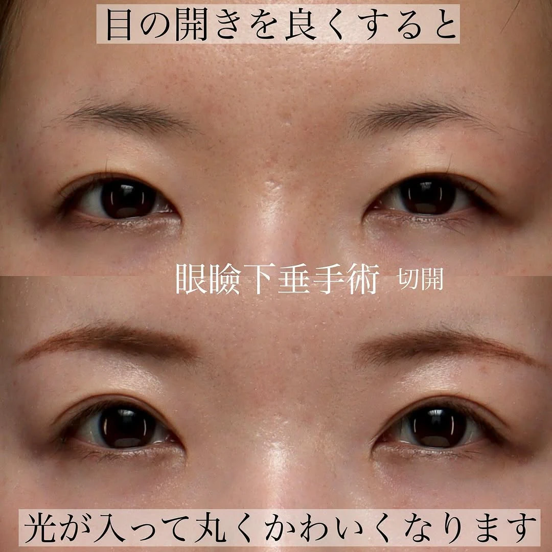 眼瞼下垂手術で黒目全体が見えるようになり目の開きと印象を改善した症例