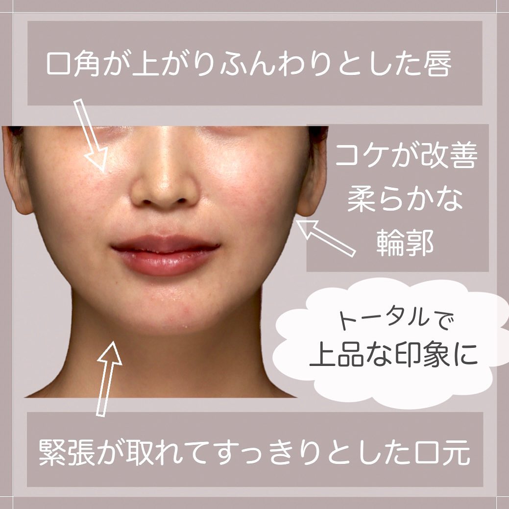 ボトックス×ヒアルロン酸（頬・唇）のトータル注入で上品な印象に整えた症例 画像3