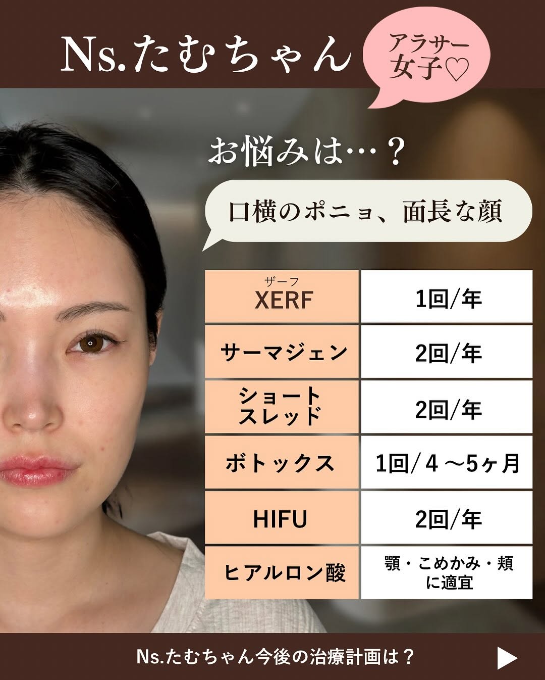 スタッフのたるみ治療年間計画｜アラサー・アラフォー看護師のリアルな施術スケジュール 画像2