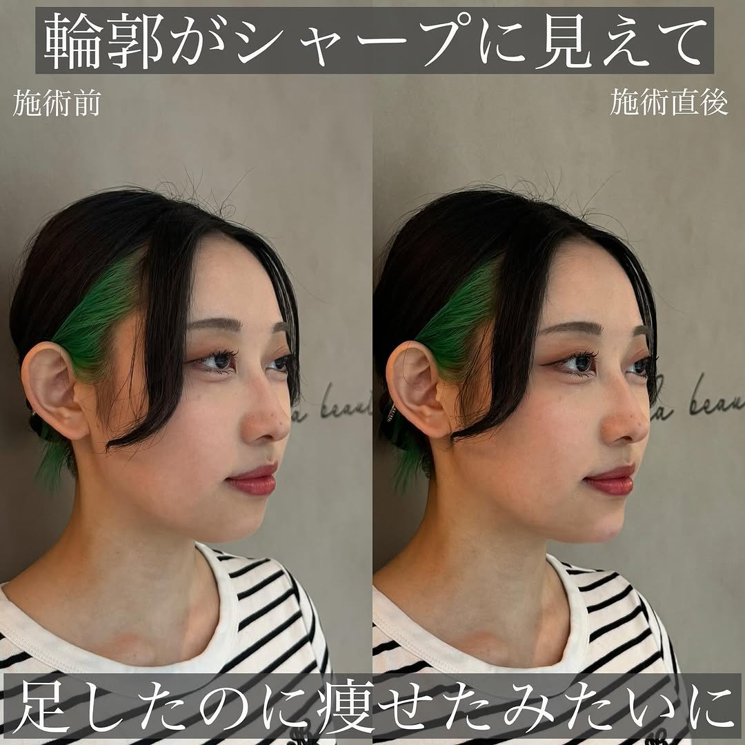 あごのヒアルロン酸で輪郭のバランスを自然に整えた症例 画像2