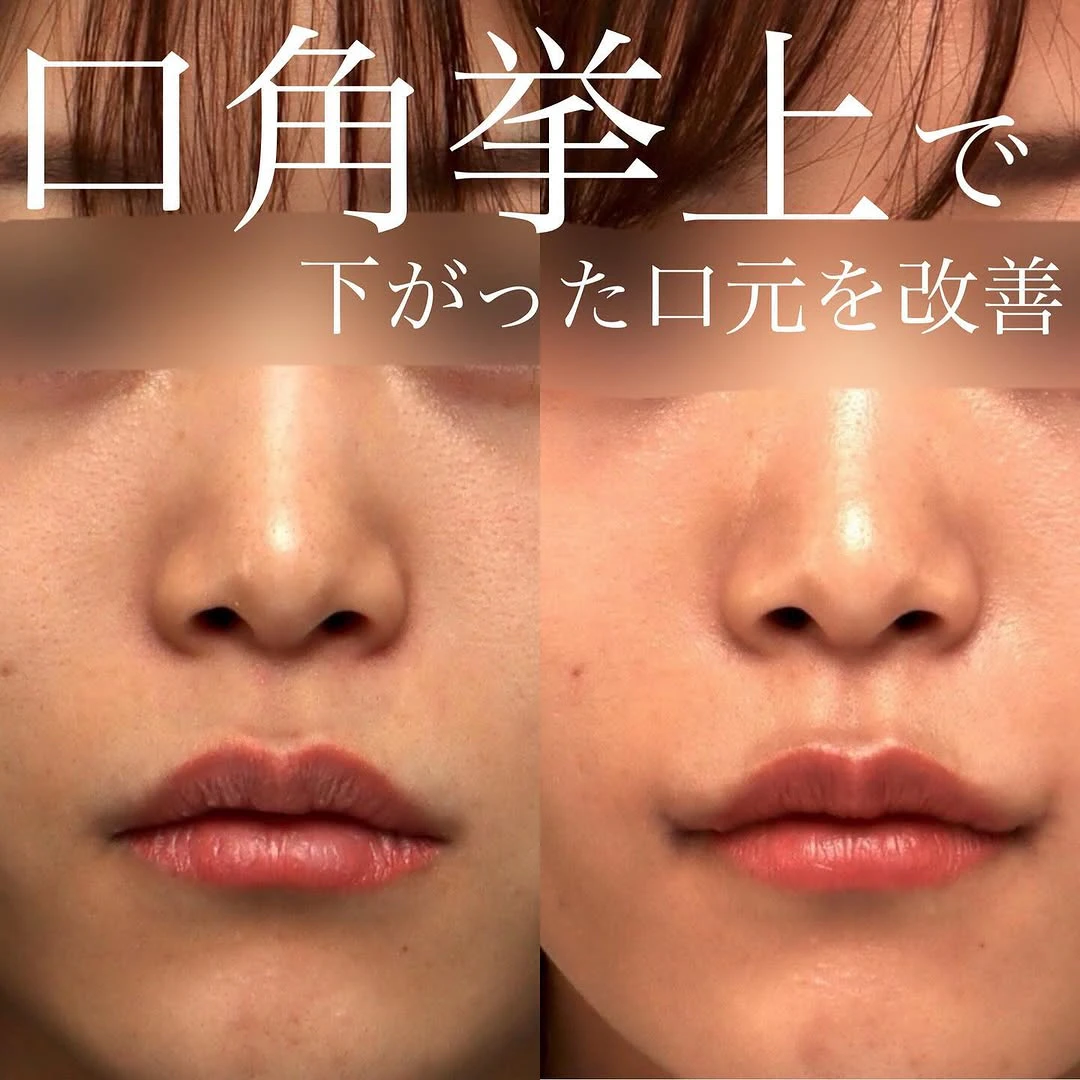 口角挙上で真顔でも斜めから見ても口角が下がっていない自然な口元に整えた症例