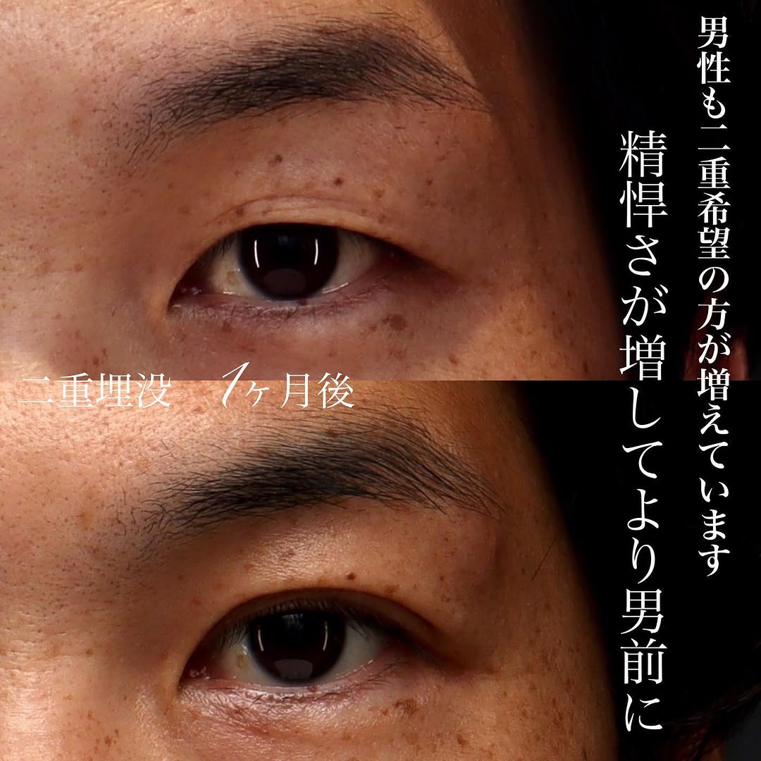 男性の二重埋没で左右差を改善し精悍な目元に（術後1ヶ月）