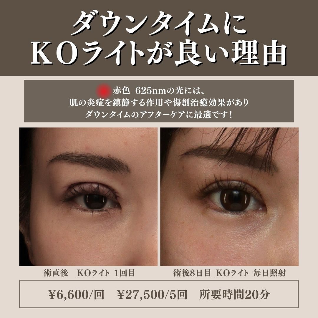 KOライトとは｜赤・青LED光でダウンタイムを短縮・肌質改善・育毛まで対応する新メニュー 画像4