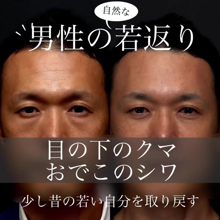 表ハムラ＋ヒアルロン酸注射＋シルキー注射で男性の自然な若返りを実現した症例（半年以上後） 画像4