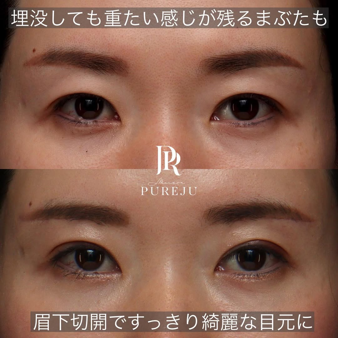 眉下切開＋二重埋没でたるみで隠れていた二重ラインをすっきり出した症例 画像4