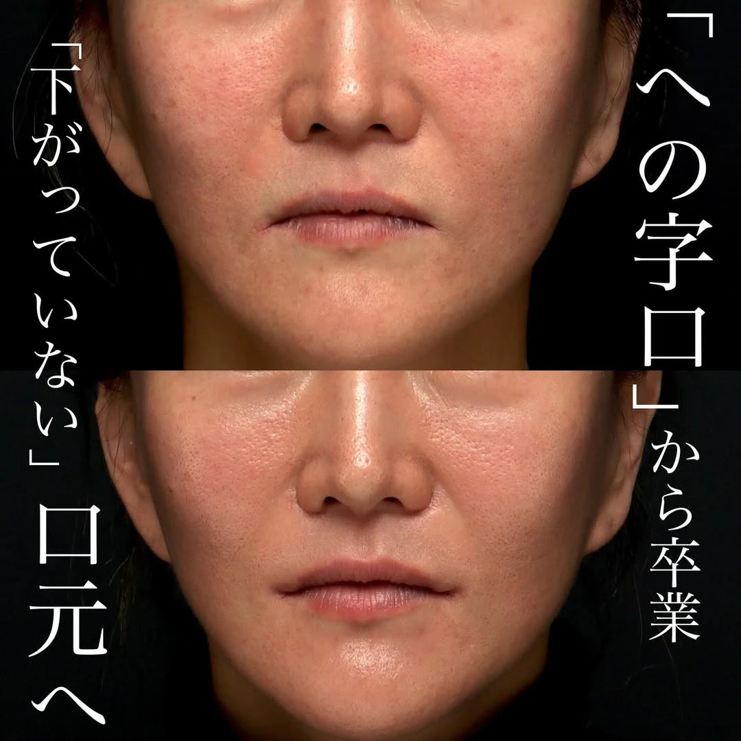 口角挙上で「口角が下がっていない」自然な口元の印象を整えた症例