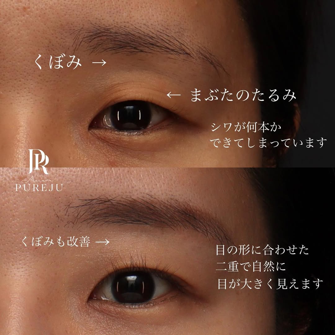骨格に合わせた自然な末広二重で周りにバレない変化を実現した症例 画像2