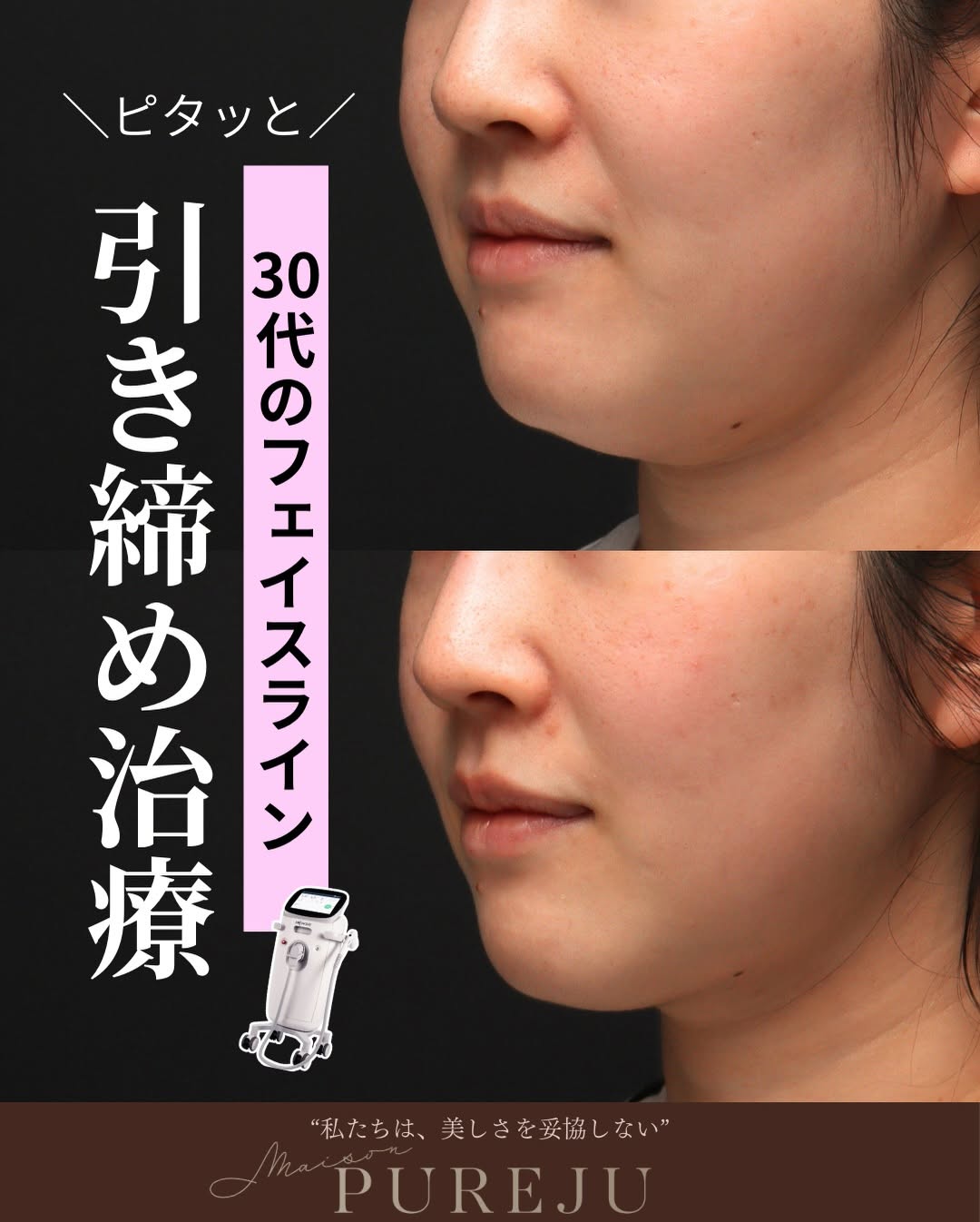 ソフウェーブで30代のフェイスラインのたるみをピタッと引き締めた症例