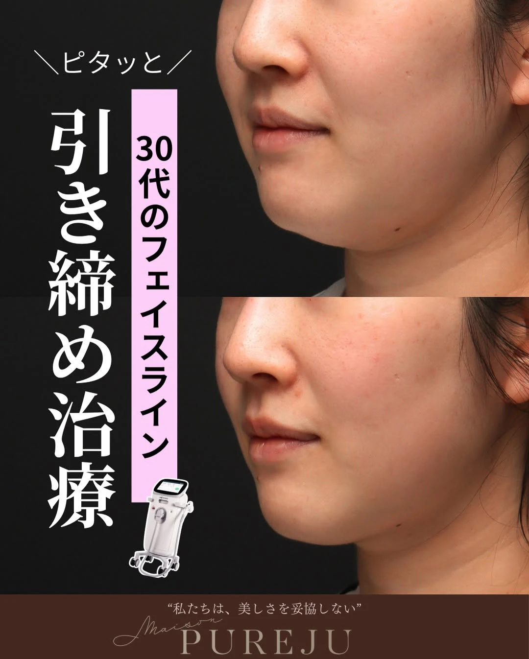 ソフウェーブで30代のフェイスラインのたるみをピタッと引き締めた症例